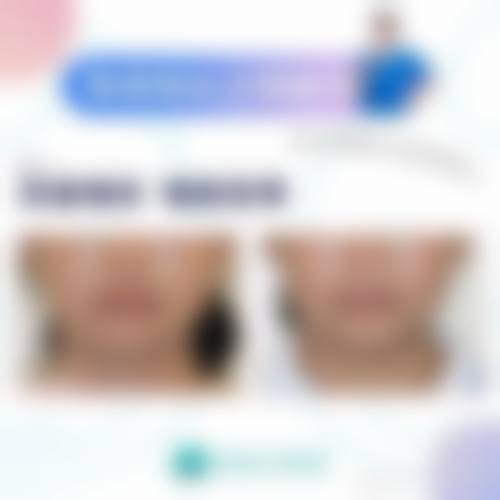 韩昇烈鼻子整形实例