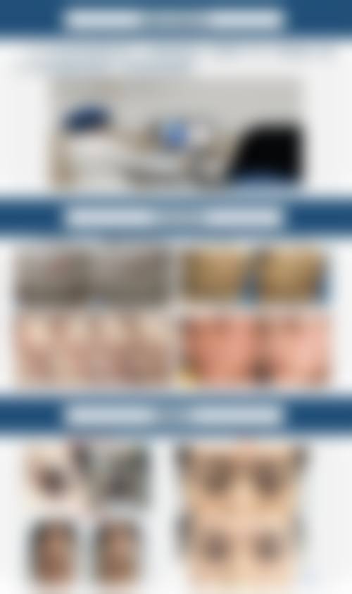 周海燕激光祛斑实例