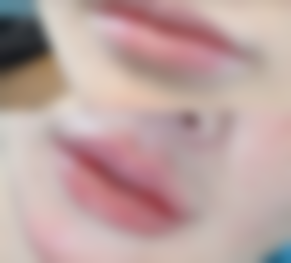 如何巧妙修复腋下手术疤痕？术后护理不可忽视