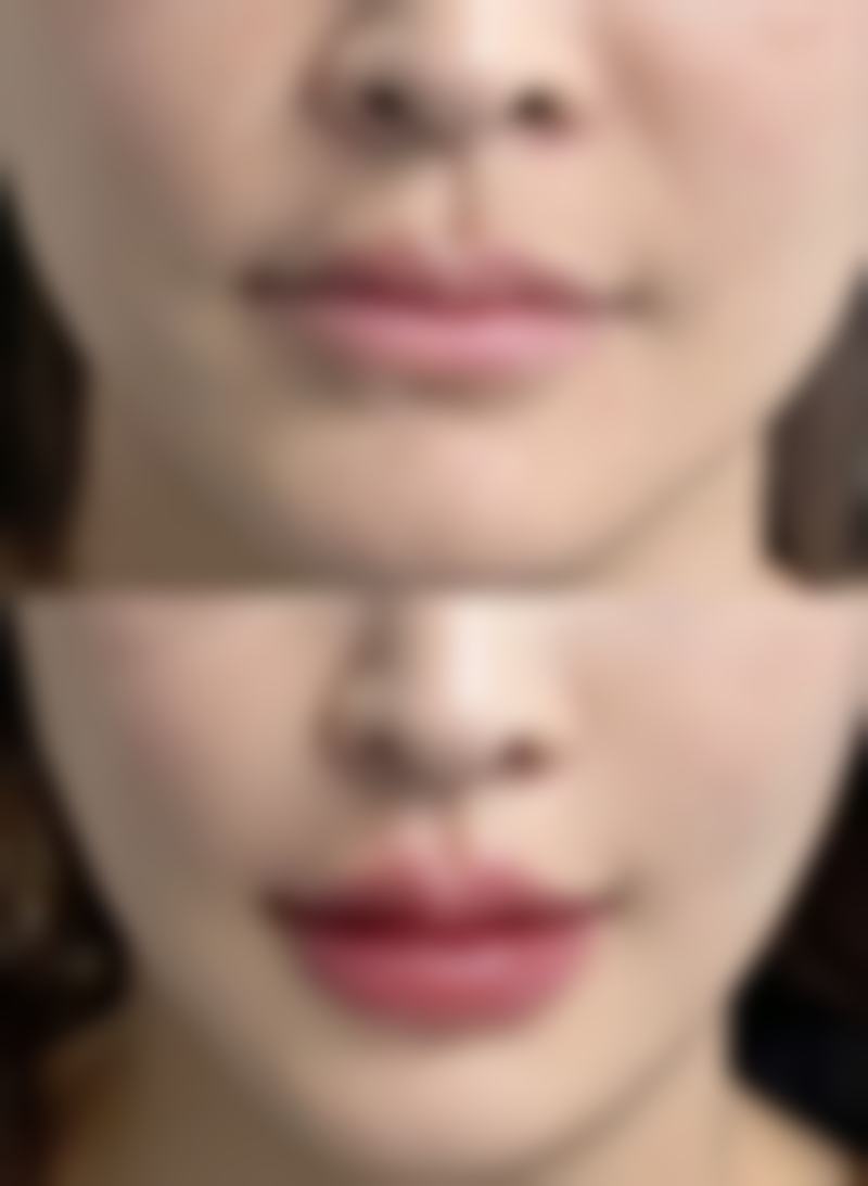 如何巧妙修复腋下手术疤痕？多种方法结合，个性化方案助您淡化疤痕重拾自信 