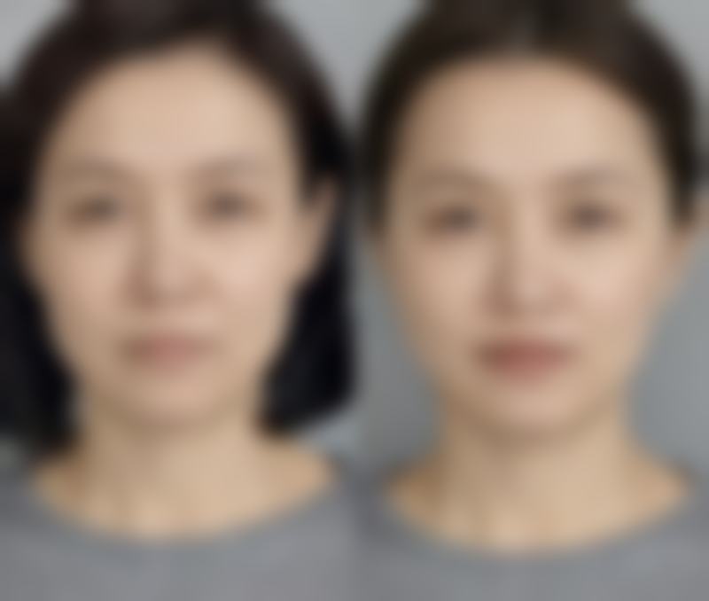 埋线双眼皮术后修复自然的时间