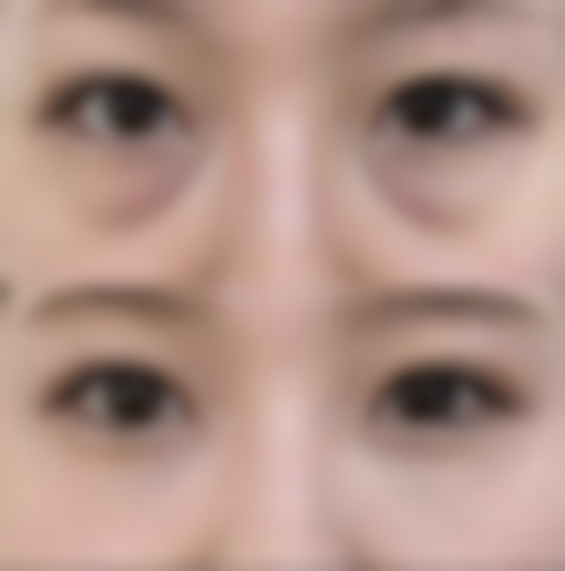 全切双眼皮开眼角后喝酒的注意事项