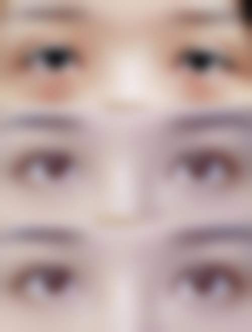 王玉如眼部整形实例