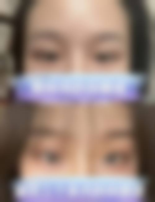 郑甫滥眼部整形实例