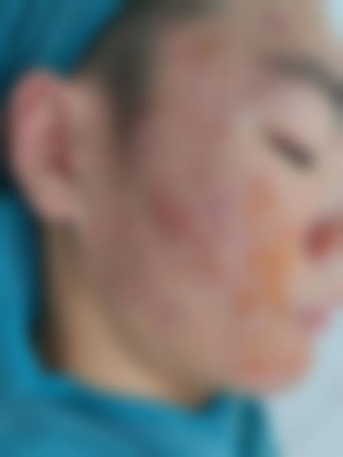 周海燕激光祛斑实例