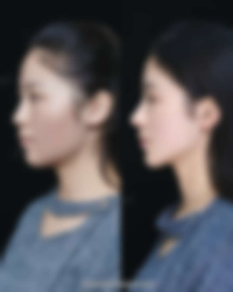 还在愁双眼皮不明显？自然协调成效更动人