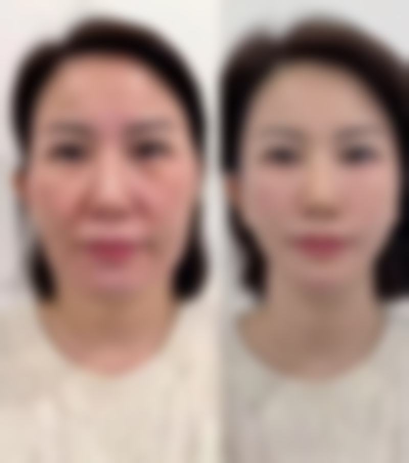 做了阴道紧缩术多久能同床?过早同床风险大