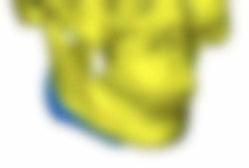 肿眼泡能切双眼皮！个性化方案精准改善，术后美观自然且恢复有保障 