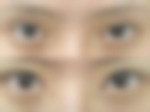 郑甫滥眼部整形实例