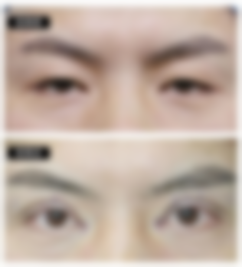 怎样去掉眼袋有成效？医院助力更可靠