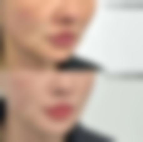 割双眼皮术后每次热敷多久