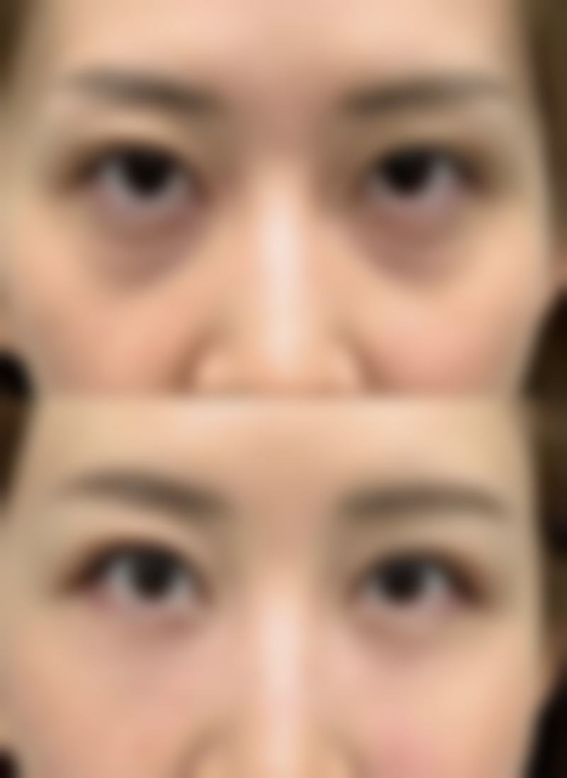 割双眼皮后需特别注意的饮食禁忌