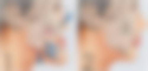 纠结隆鼻选哪个？成效和价格也得看