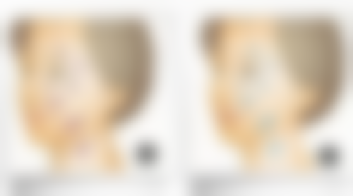 术后护理不能忘：让双眼皮修复得又快又好