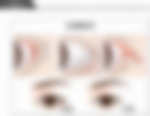 眼皮条件决定美眼方案：双眼皮埋线与切开怎么选，各有啥优势？ 