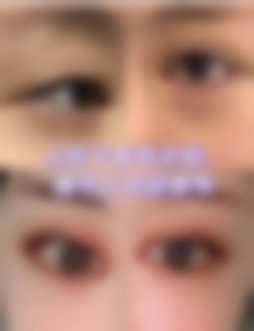 沈珍熙眼部整形水平怎么样可靠吗？