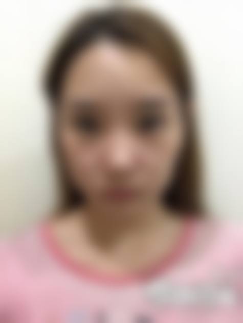 朱建生韩式隆鼻水平怎么样可靠吗？