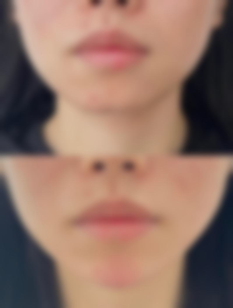 揭秘超有效去眼袋术后护理:修复成效更佳