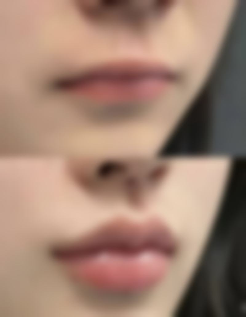 新生儿单眼皮何时变双有迹可循：医美机构解锁双眼皮秘密之方法对比