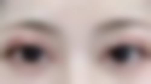 切开法修复价格与成效，性价比极高