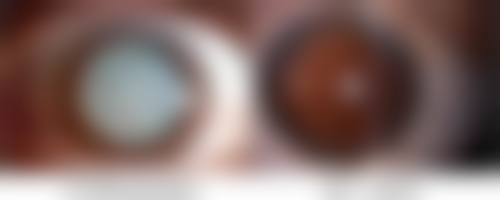 开眼角切双眼皮多久能恢复？一般1 - 3个月基本自然，6个月左右完全定型 