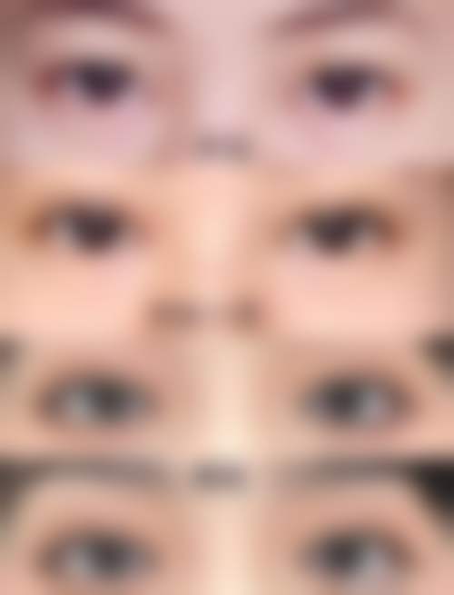 王玉如眼部整形实例