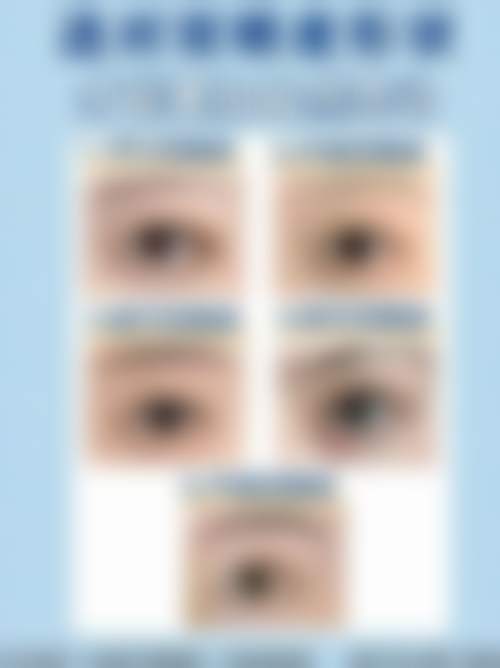 王玉如眼部整形水平怎么样可靠吗?