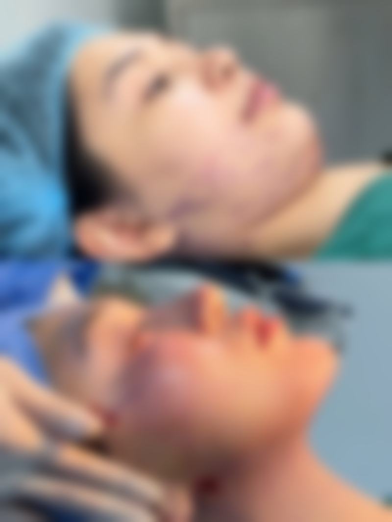 切开法修复术后修复，一天比一天美