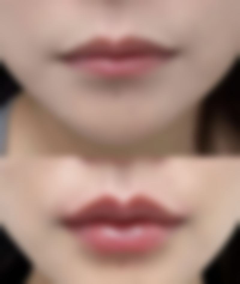 手术祛眼袋效果能维持多久？5 - 10 年不是梦，多种因素助你长久告别眼袋！ 