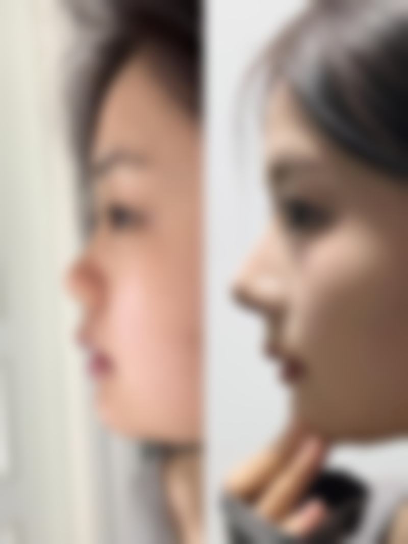 如何进行个性化治疗？专属方案定制，疤痕修复更精细！