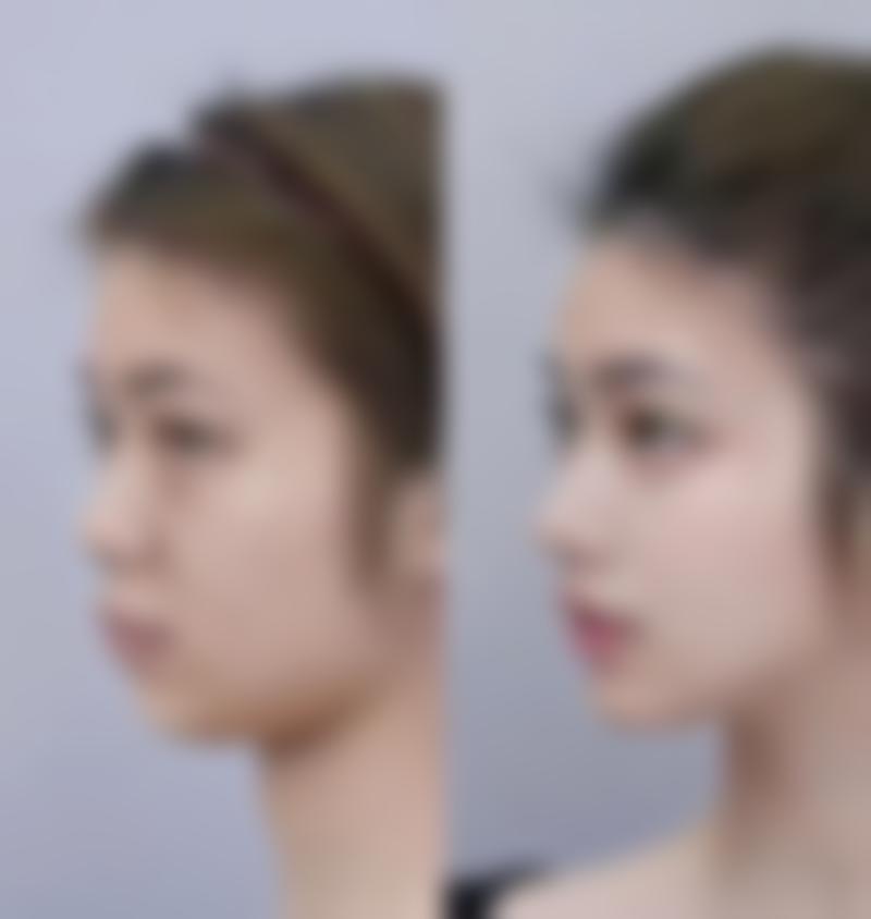 六、宁波摩范植发门诊部价格表:(仅供参考)