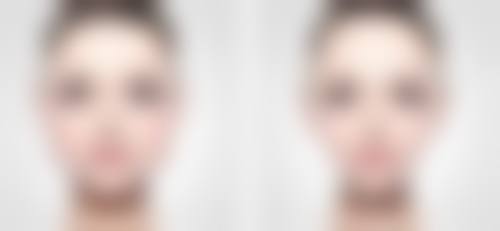 埋线双眼皮后常睁眼有必要吗？加速消肿、持久成型，睁眼运动助力完美恢复