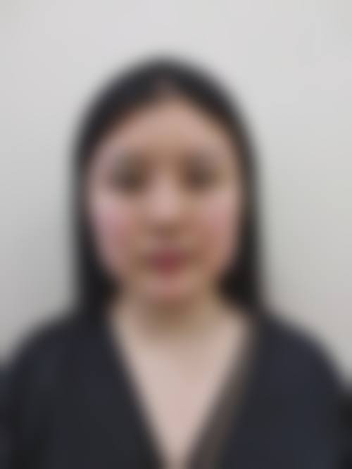 秦志慧自体脂肪填充水平怎么样可靠吗？