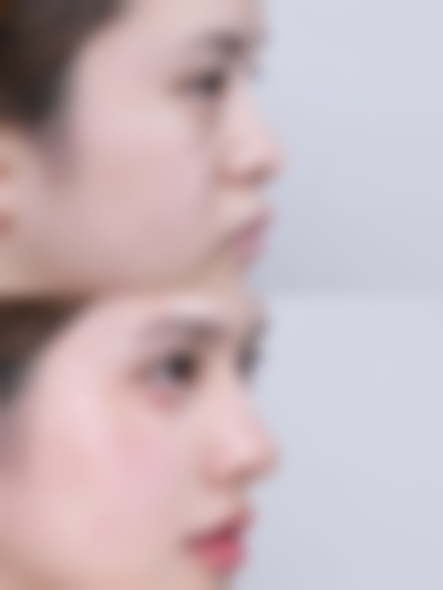 假体隆胸后哺乳功能会受影响吗？详细解析隆胸与哺乳的关系