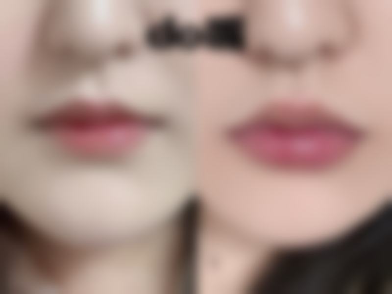 假体隆胸与生育的综合考量：如何科学规划保护母婴健康？