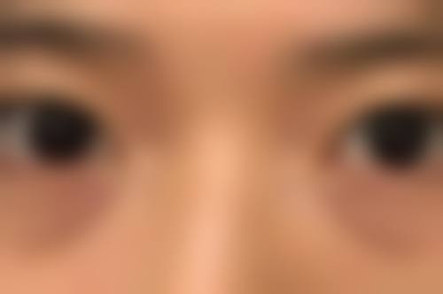 非裸露部位疤痕：功能影响是关键