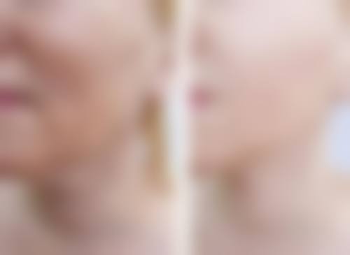 双眼皮术后两月肉条仍在,术后护理与修复建议