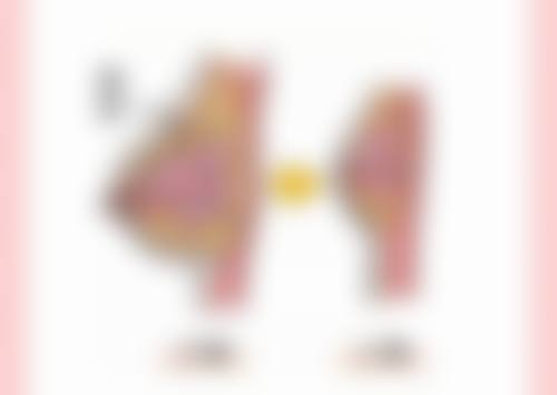 做假体隆胸手术后修复需要多久？时间因人而异