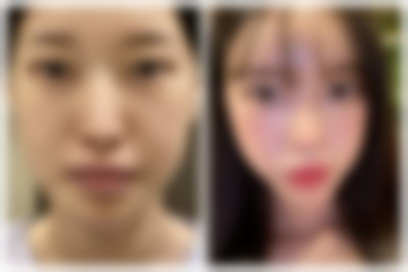 双眼皮术后两月肉条仍在,相关医院情况介绍