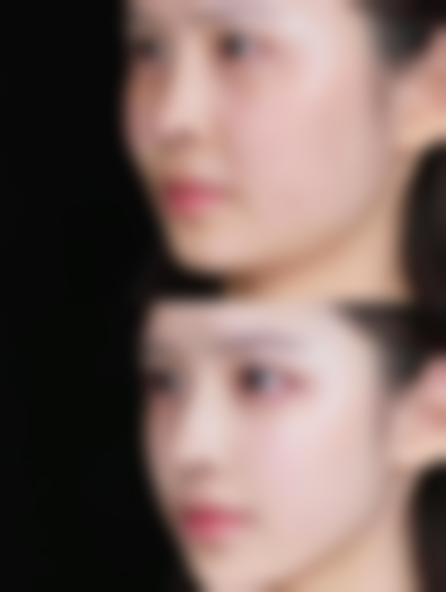 手术方法，有效去除顽固眼袋