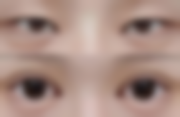 揭秘三:假体隆胸的具体修复时间线