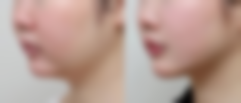 就医建议与注意事项，保护消除眼袋成效