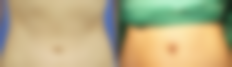 如何遵循修复建议塑造理想双眼皮？