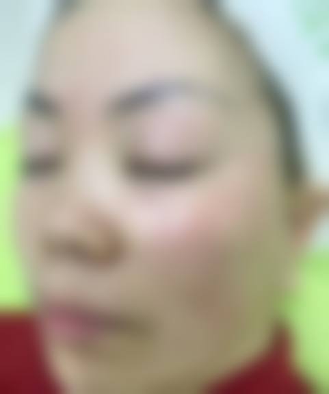 陈剑祛黄褐斑实例