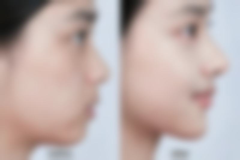 哪些地方双眼皮修复效果佳？揭秘自然无痕、精细矫正的优质修复秘诀 