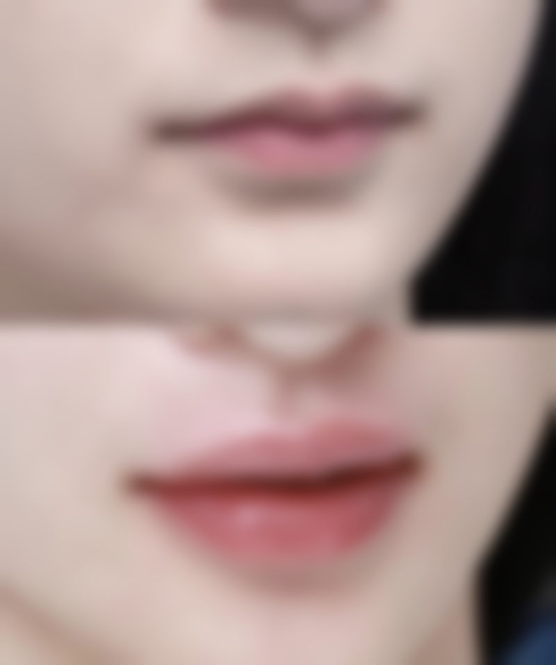 自体毛囊移植:成活率高,成效自然持久