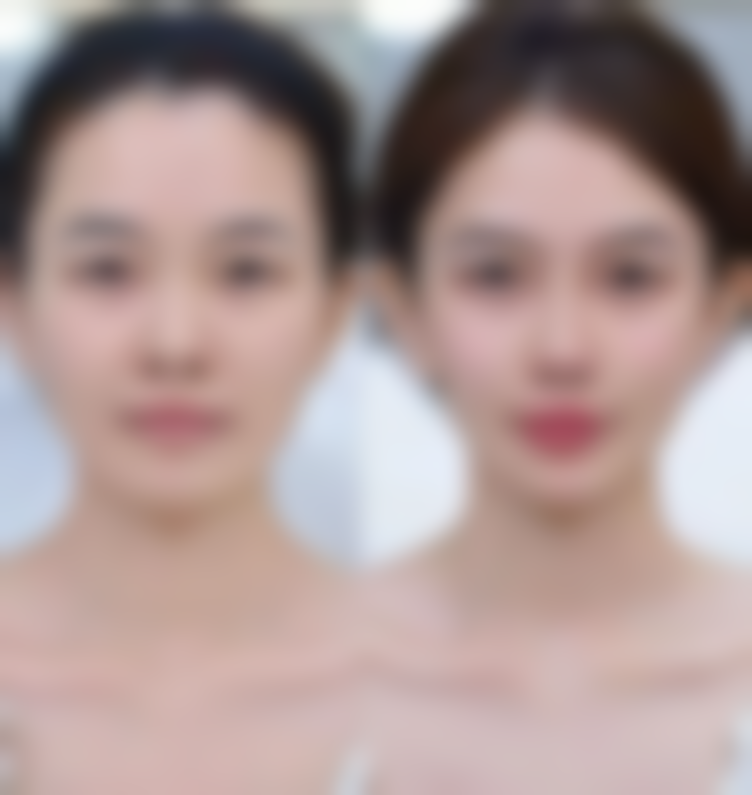 橄榄油能消除眼袋吗？正规医美机构的选择与优势