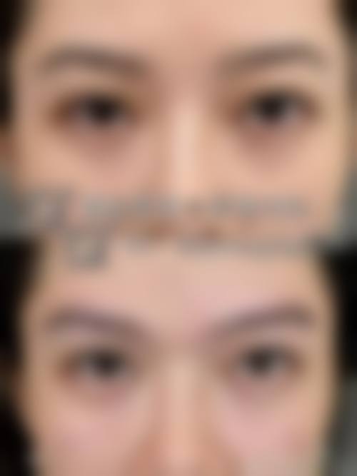 赵烨面部年轻化注射整形实例