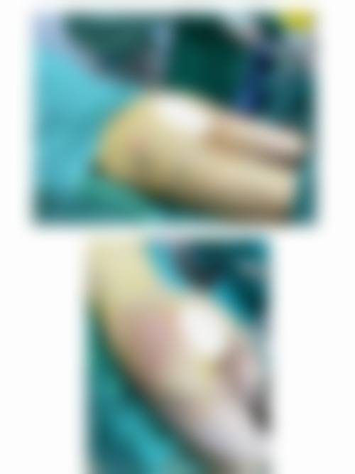 樊莎莎激光／光子综合治疗水平怎么样可靠吗？