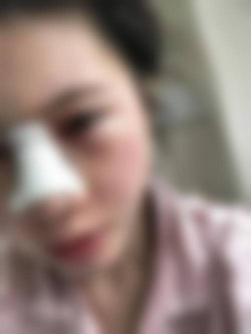 樊莎莎激光／光子综合治疗实例